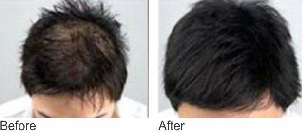 мезотерапия волос до и после