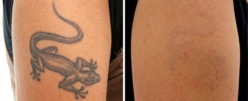 сведение татуировок фото до и после