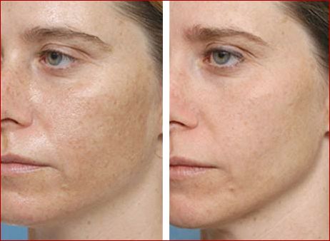 Resultado de imagem para limpeza de pele ultrassÃ´nica antes e depois