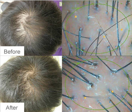 мезотерапия волос фото до и после