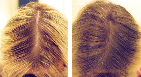 мезотерапия для волос фото до и после