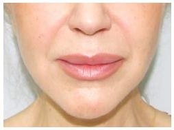 увеличение губ гиалуроновой кислотой фото до и после