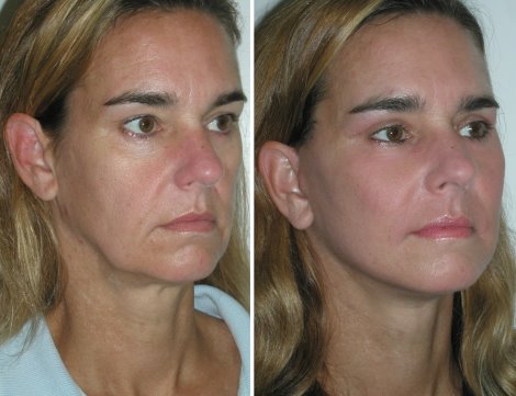Лицевые имплантаты: фото до и после