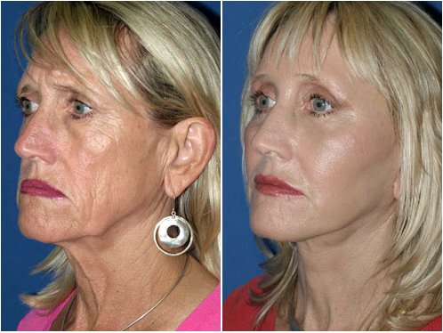 Лицевые имплантаты: фото до и после