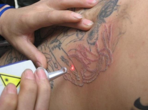 лазерное удаление тату