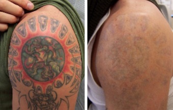 Удаление татуировок фото до и после