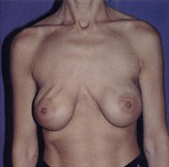 сморщивания имплантов груди