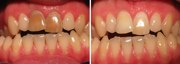 внутриканальное отбеливание зубов фото до и после