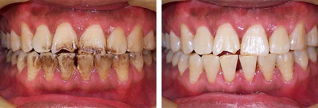 механическое отбеливание зубов до и после