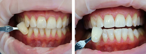лазерное отбеливание зубов фото до и после