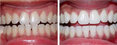 Фотоотбеливание зубов фото до и после