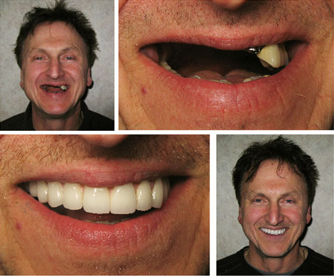 протезирование передних верхних зубов
