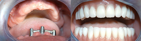 Протезирование зубов при полном отсутствии зубов