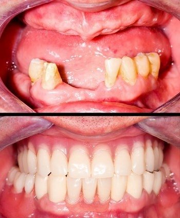 Протезирование передних нижних зубов