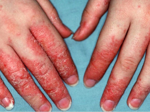 Атопический дерматит на пальцах рук