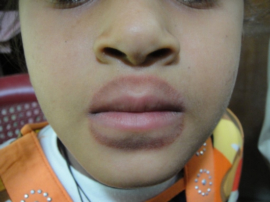 Атопический дерматит на губах и вокруг рта