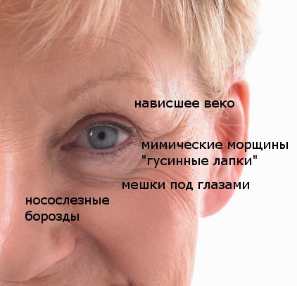 старение кожи вокруг глаз