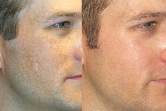 Фотоотерапия при пигментации фото до и после