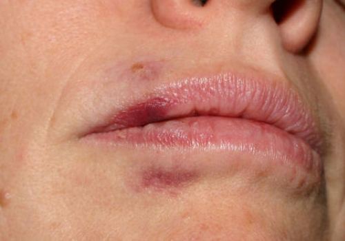 Гематома губ после контурной пластики фото