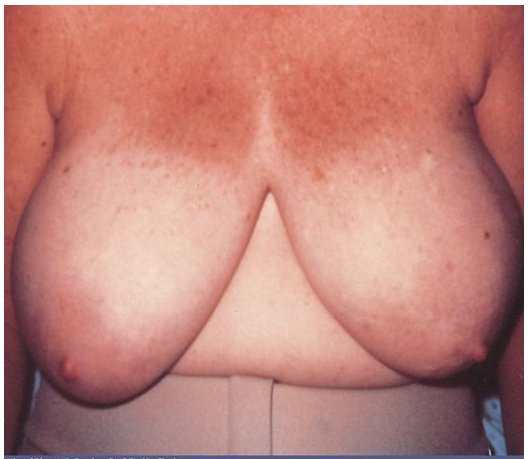 Асимметрия груди: фото