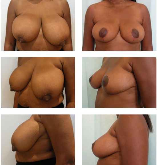 Асимметрия груди: фото