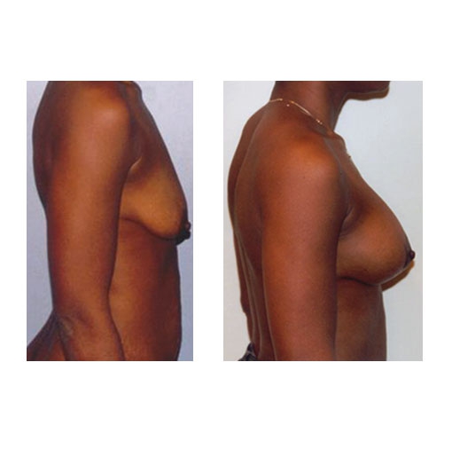 Подтяжка груди нитями: фото до и после