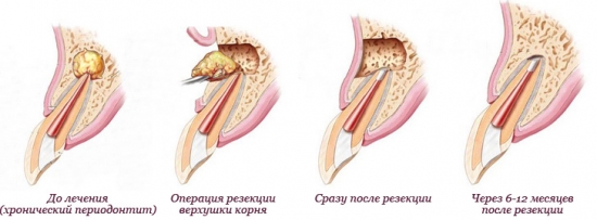 киста зуба операция