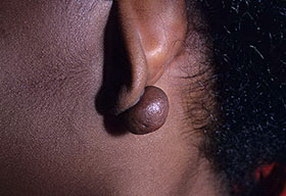 келоидный рубец на мочке уха