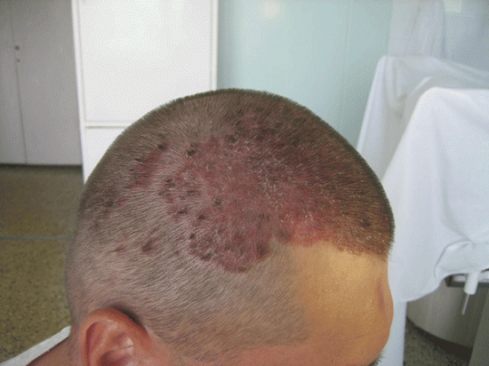 Псориаз волосистой части головы: фото
