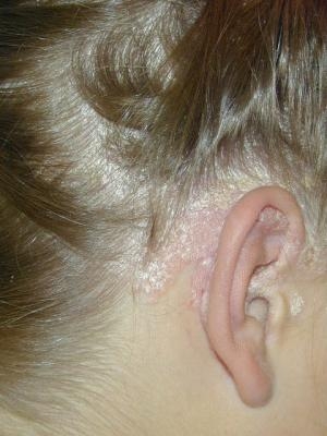 Псориаз волосистой части головы: фото