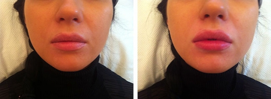 Гиалуроновая кислота в губы: фото до и после