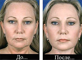 Круговая подтяжка лица: фото до и после