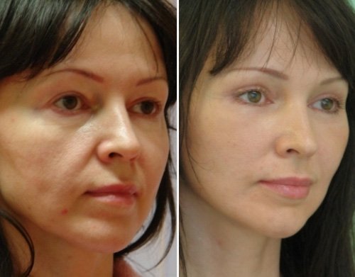 Круговая подтяжка лица: фото до и после