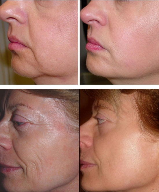 Салонные процедуры для подтяжки кожи лица
