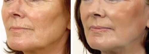 Лазерное омоложение кожи лица отзывы косметологов thumbnail