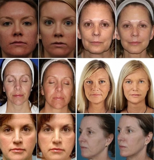 Лазерное омоложение кожи лица отзывы косметологов