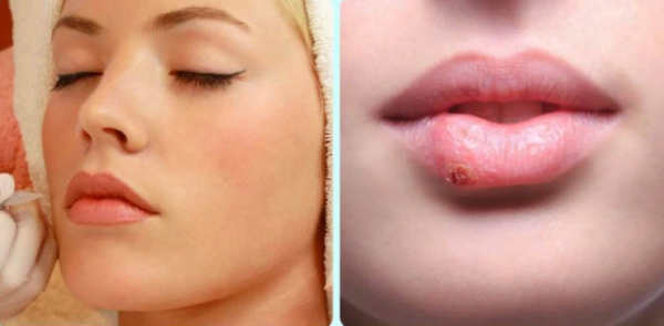 Перманентный макияж губ все губы в герпесе